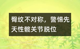 臀紋不對(duì)稱，警惕先天性髖關(guān)節(jié)脫位